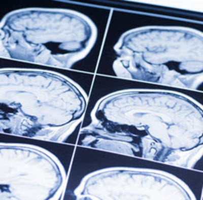 BrainInj3 BrainInj3