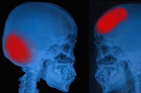 HeadInjury