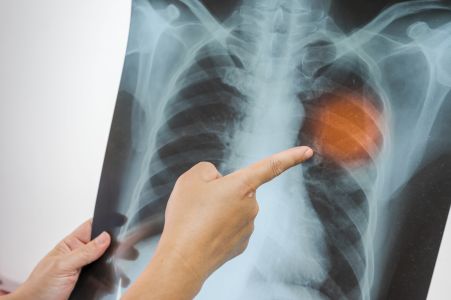 BrokenRib